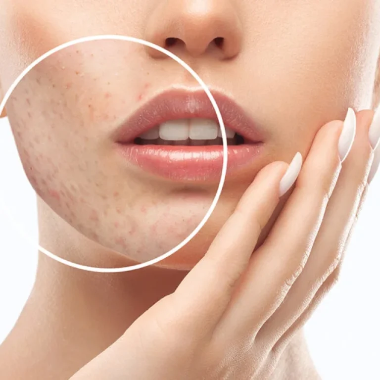 grade-2-acne-scar